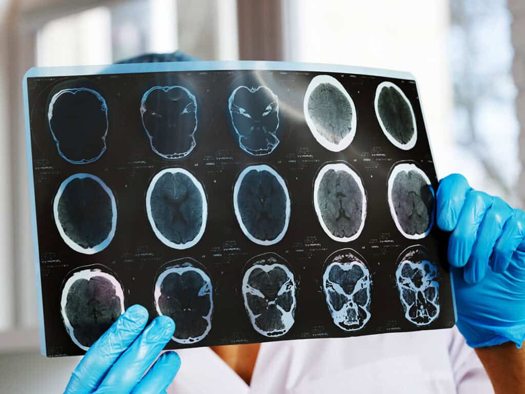 Medical professional reviewing brain scan